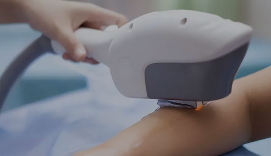 Diode Laser Hair Removal