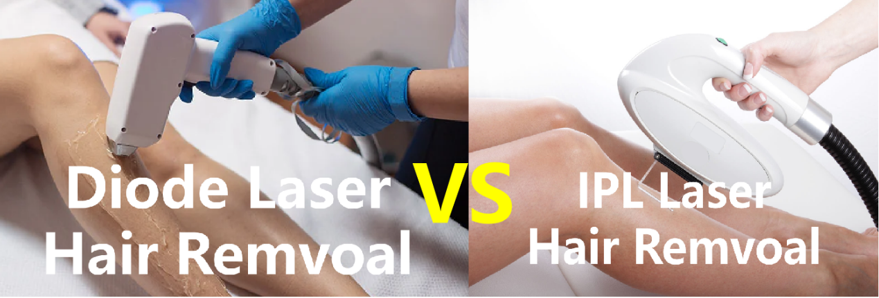 IPL VS DIODE LASER HAIR REMOVAL